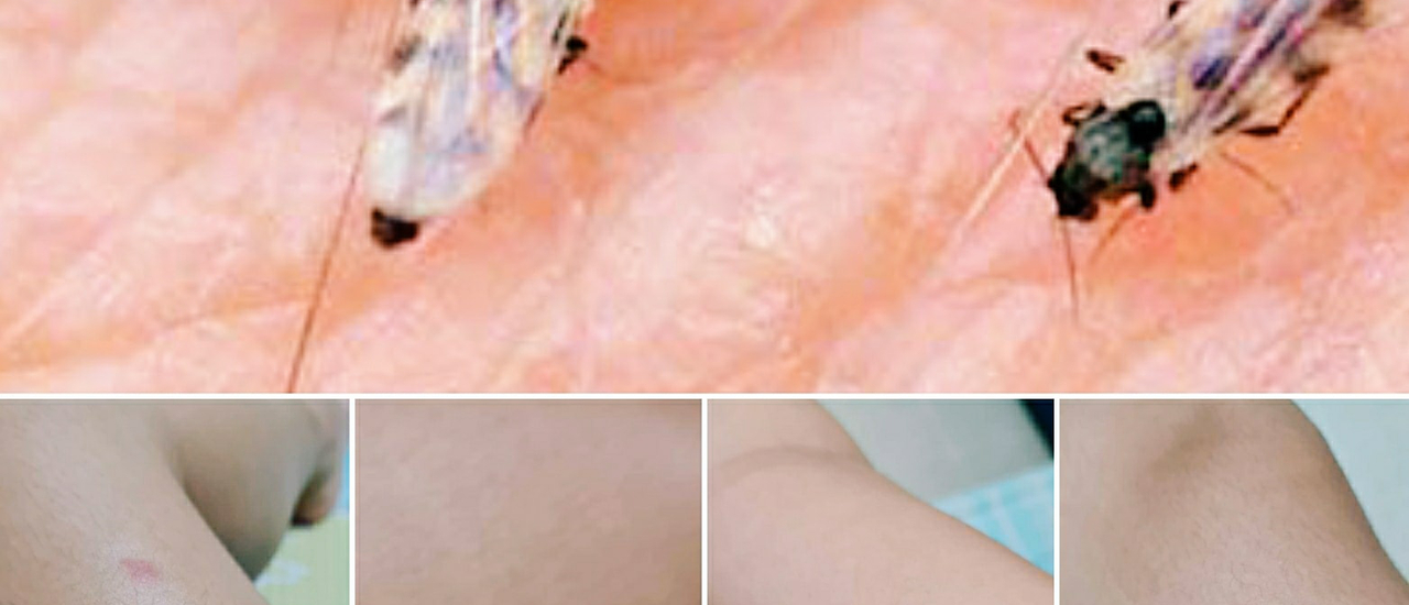 cover วิธีรักษา ป้องกัน เมื่อถูกริ้นทะเลกัด